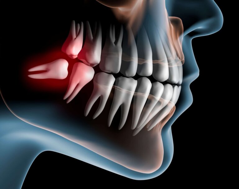 Beyond Wisdom: Navigating the Path to Comfort with Wisdom Teeth Removal